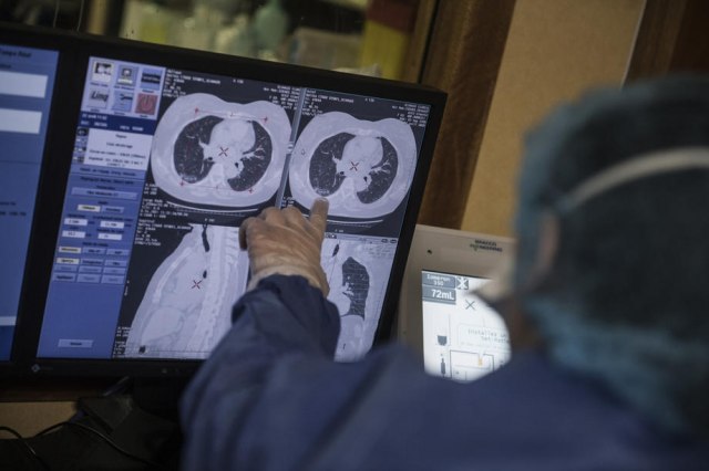 Šest simptoma koji bi mogli da ukažu da imate tumor na mozgu